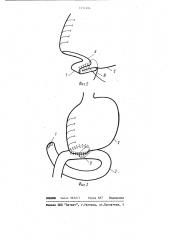 Способ резекции желудка (патент 1131494)