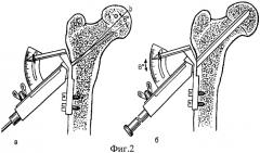 Устройство для прецизионной остеоперфорации (патент 2410058)