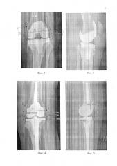 Способ ревизионного и сложного первичного эндопротезирования коленного сустава при дефектах суставных поверхностей (патент 2611911)