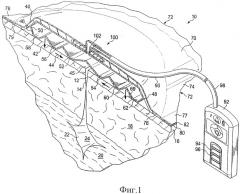 Узлы повязки пониженного давления для использования в приложении закрывающей силы (патент 2470672)
