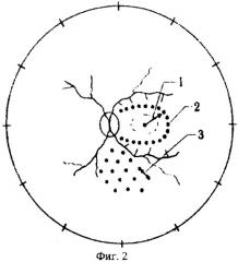 Способ лечения тромбоза центральной вены сетчатки и ее ветвей (патент 2337656)