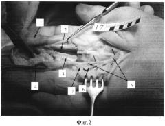 Способ восстановления утраченного первого пальца кисти (патент 2550935)