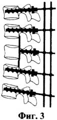 Способ вертебропластики при переломах тел позвонков (патент 2462206)