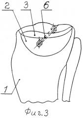 Способ оперативного лечения компрессионных переломов мыщелков большеберцовой кости (патент 2283051)