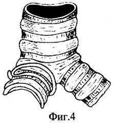 Способ обработки культи главного бронха (патент 2271155)