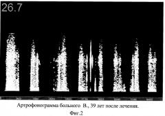 Способ лечения посттравматического деформирующего остеоартроза (патент 2384352)