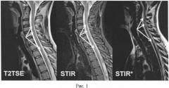 Способ выявления патологических очагов в спинном мозге при рассеянном склерозе (патент 2472433)