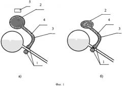 Уретральный магнитоуправляемый сфинктер (патент 2651089)