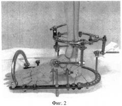 Способ остеосинтеза аппаратом орто-сув для устранения вывихов в голеностопном суставе (патент 2547798)