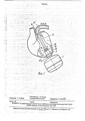 Искусственный желудочек сердца (патент 1703123)