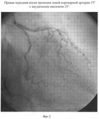 Способ диагностики коронарографического сосудистого индекса (патент 2341193)