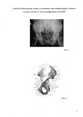 Способ стабилизации лонного сочленения при повреждениях тазового кольца типа в и с по классификации ao/asif (патент 2600490)