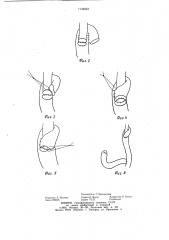 Способ наложения эзофагоеюноанастомоза (патент 1132923)