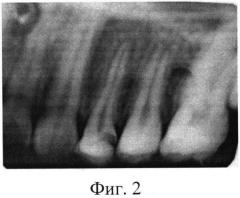 Способ лечения хронического фиброзного пульпита постоянных зубов с несформированными корнями (патент 2566202)