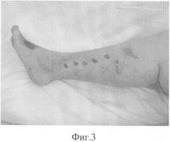 Способ лечения больных с недостаточностью клапанов перфорантных вен голени, осложненной трофическими язвами (патент 2328997)