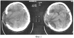 Способ лечения черепно-мозговой травмы (патент 2366466)