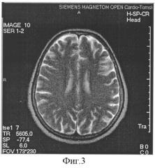 Способ определения устойчивости головного мозга к гипоксии (патент 2314747)