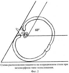 Способ лечения заболеваний пищевода (патент 2269941)