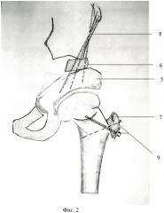 Способ выполнения транспозиции вертлужной впадины в ходе двойной остеотомии таза (патент 2474393)