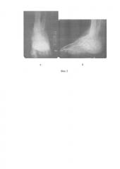 Способ возмещения остеомиелитической полости метадиафизарной области большеберцовой кости (патент 2582051)