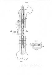 Устройство для фиксации фрагментов трубчатых костей (патент 990209)