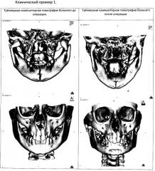 Способ лечения переломов мыщелкового отростка нижней челюсти со смещением и вывихом головки под основание черепа у детей с использованием эндоскопической техники (патент 2455952)
