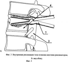 Способ переднего транспедикулярного спондилодеза (патент 2331378)