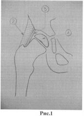 Способ лечения дефекта головки бедренной кости у детей с детским церебральным параличом (патент 2452423)