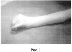 Способ лечения врожденной разгибательной контрактуры лучезапястного сустава у детей с артрогрипозом (патент 2506917)