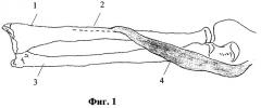 Способ хирургического лечения пронационной контрактуры предплечья при детском церебральном параличе (патент 2269319)