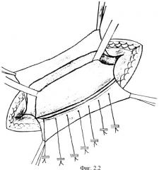Модифицированная пластика задней стенки пахового канала при грыжесечении (патент 2294699)