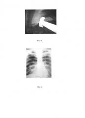 Способ лечения спонтанного пневмоторакса (патент 2654419)