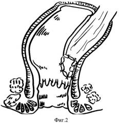 Способ восстановления непрерывности толстой кишки (патент 2444313)