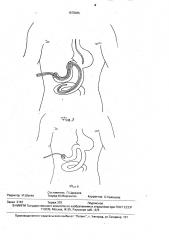 Способ лечения несостоятельности швов дуоденальной культи после резекции желудка по бильрот-11 (патент 1678385)