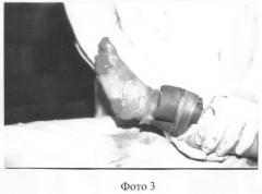 Способ пластики кожных покровов конечностей после ранней некрэктомии (патент 2248757)