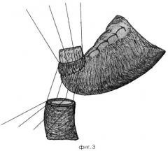 Способ формирования инвагинационного арефлюксного гастродуоденоанастомоза (патент 2364351)