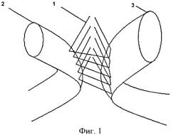 Способ формирования кишечного анастомоза конец в конец при различных диаметрах анастомозируемых концов (патент 2423937)