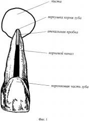 Способ лечения хронического гранулематозного периодонтита (патент 2562101)