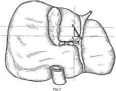 Способ рационального выделения желчного протока iv сегмента для анастомоза с тонкой кишкой (патент 2447844)
