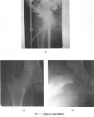 Способ лечения юношеского эпифизеолиза головки бедренной кости (патент 2256418)
