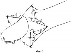 Способ циркумцизии (патент 2387393)