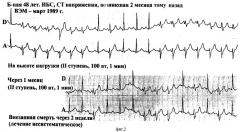 Способ диагностики ишемических желудочковых нарушений ритма у больных ишемической болезнью сердца (патент 2280402)