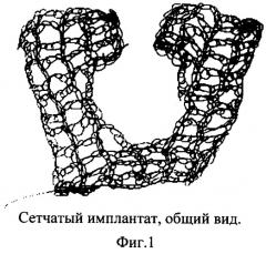 Способ пластики грыжи пищеводного отверстия диафрагмы (патент 2261663)