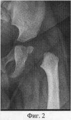 Способ лечения врожденной варусной деформации шейки бедра (патент 2477094)