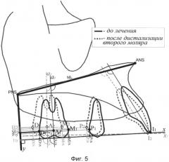 Способ дистализации боковой группы зубов верхней челюсти (патент 2561892)