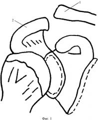 Способ замещения ключично-акромиальной связки при вывихе акромиального конца ключицы (патент 2339329)