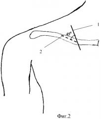 Оперативный доступ при хирургическом лечении переломов ключицы (патент 2413470)
