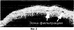 Способ исследования фильтрационной подушки после операции непроникающей глубокой склерэктомии (патент 2319474)