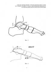 Способ предоперационного планирования хирургической коррекции деформации стопы на уровне среднего отдела (патент 2639430)
