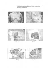 Способ одномоментной реконструкции молочной железы при органосохраняющем хирургическом лечении рака в наружных квадрантах (патент 2597143)
